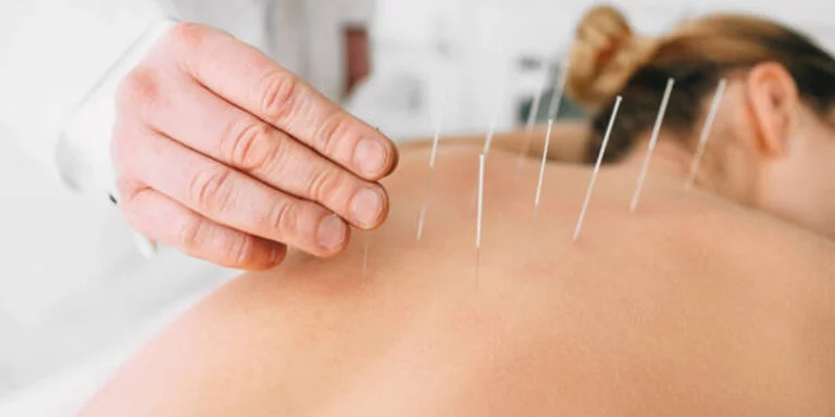 image of a woman getting acupuncture in her back